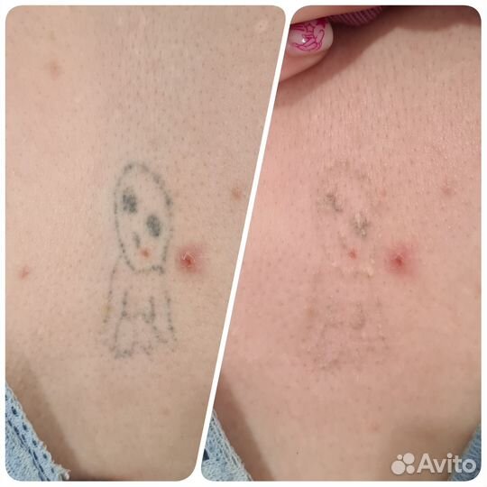 Удаление татуировки/татуажа лазером