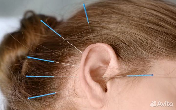 Иглоукалывание