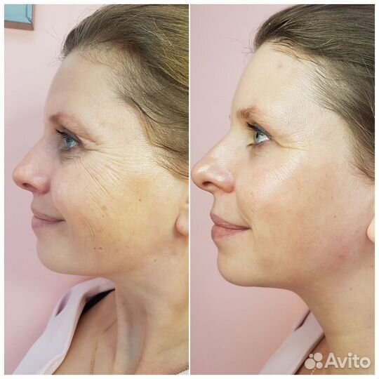 Модели на Кислородное Омоложение Век (бесплатно)