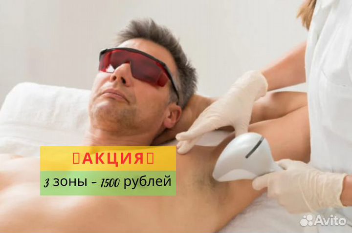 Лазерная эпиляция