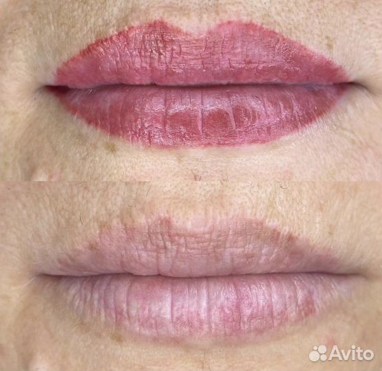 Удаление татуажа перманента мини - тату