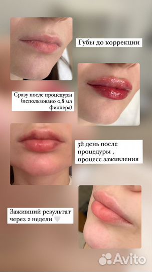 Ищу модель на контурную пластику губ