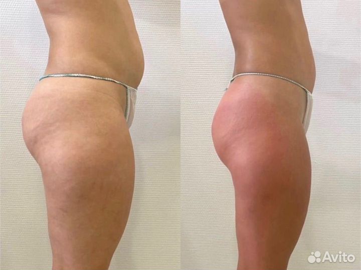 Похудение без диет и спорта. Индиба