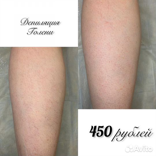 Депиляция воском: бёдра