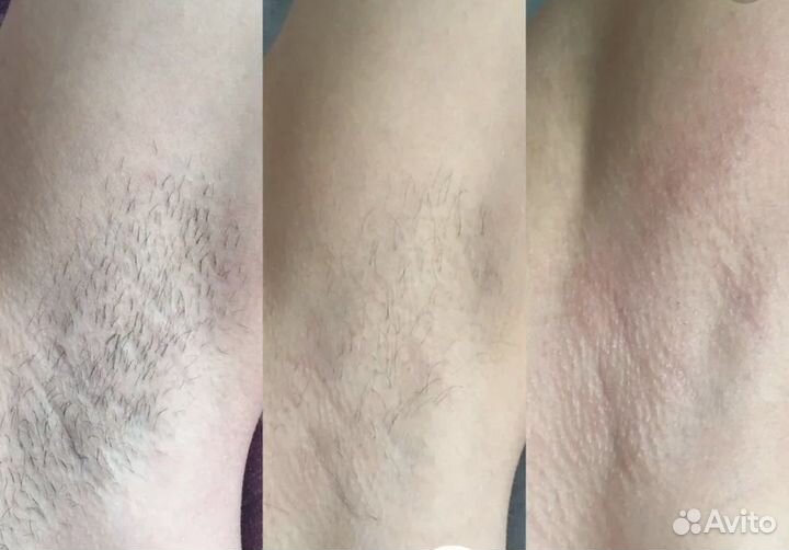 Лазерная Эпиляция