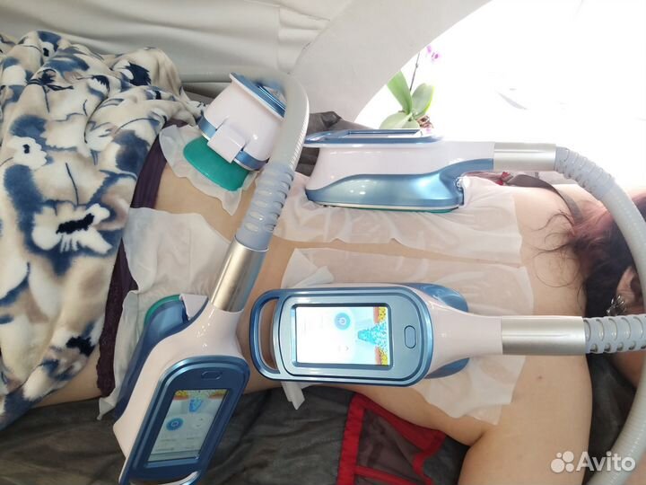 Процедура криолиполиз