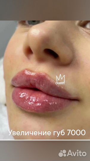 Косметолог. Губы. Ботокс