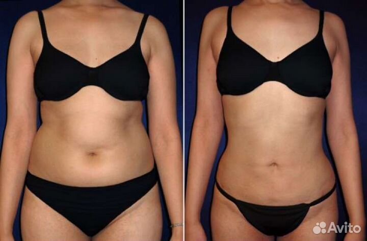 Модели на бесплатную прессотерапию живота