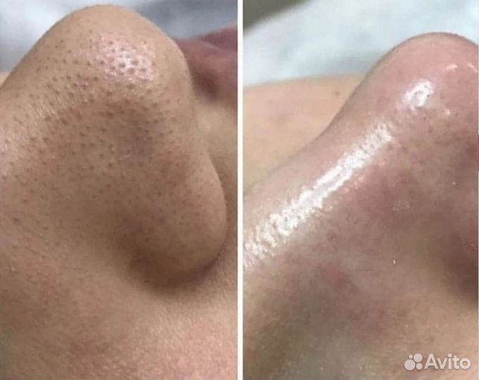 Чистка лица /МИКРОТОКИ