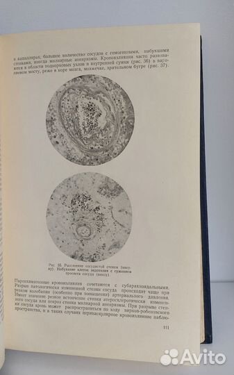 Боголепов Н.К. Коматозные состояния 1962г