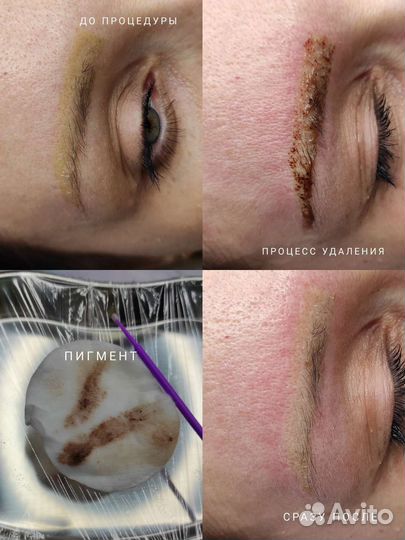 Удаление татуажа и татуировок