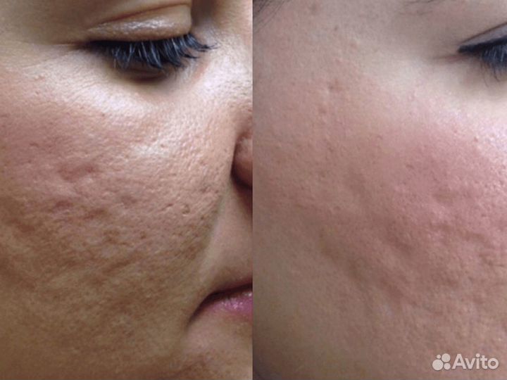 РФ - лифтинг / RF лифтинг лица и тела