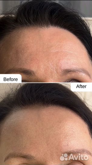 Врач косметолог. Увеличение губ. Ботокс