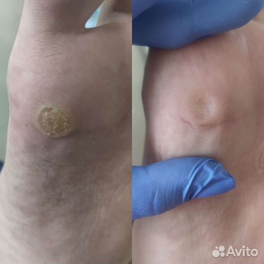 Лечебный педикюр