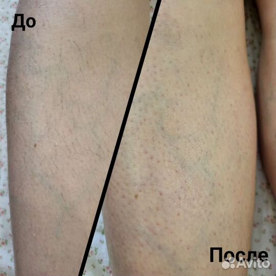 Ищу модель на депиляцию воск/ сахар