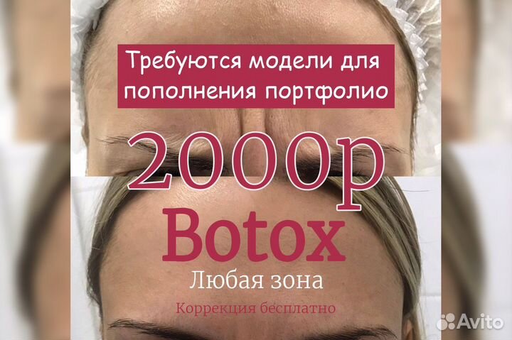 Ботулинотерапия