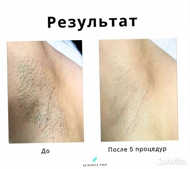 Аппарат для эпиляции Lumines MaxOne 1200W