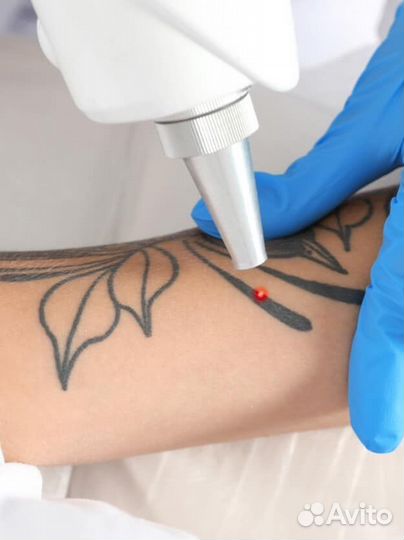 Лазерное удаление тату и нежелательного татуажа