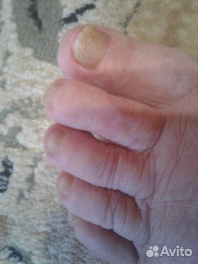 Лечебный педикюр проблемных ног