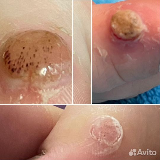 Педикюр. Подология