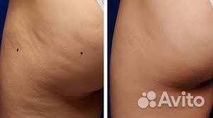 Антицеллюлитный массаж/коррекция фигуры