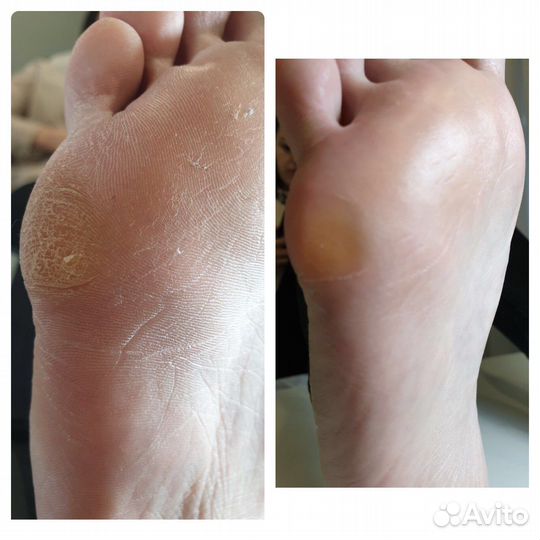 Педикюр,выезд на дом