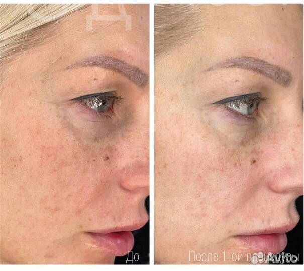 DermaQuest Пилинг мангобрайт - Набор на 4 проц