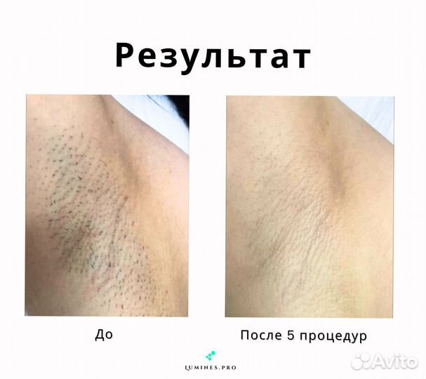 Диодный лазер Люминес Max One 1200 Вт