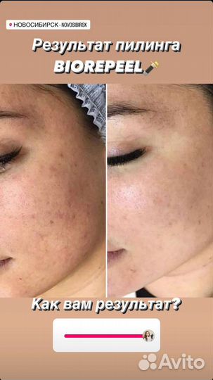 Пилинг Биореепил