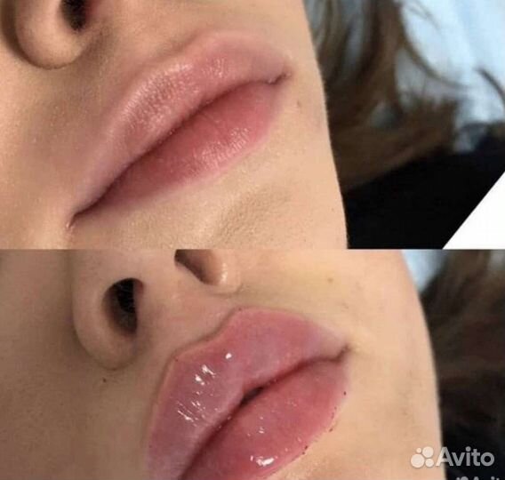 Увеличение губ, пластика губ