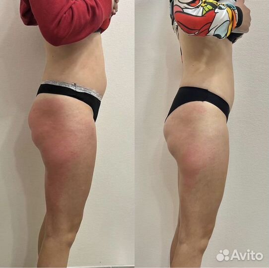 Антицеллюлитный массаж с эффектом сразу