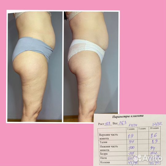 LPG массаж,Коррекция фигуры