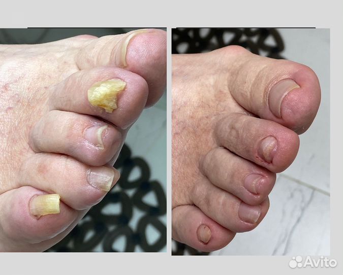 Педикюр подолог