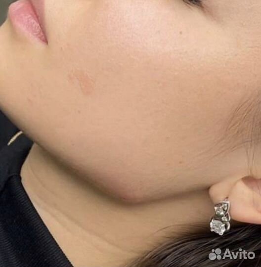 Биоревитализация