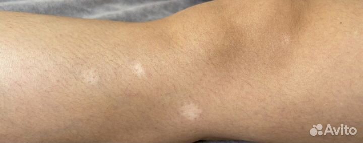 Камуфляж шрамов / рубцов (перманент )