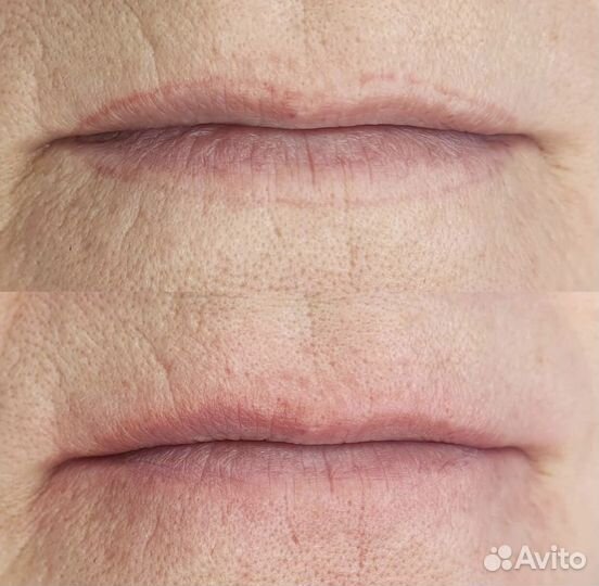 Удаление татуажа перманента мини - тату