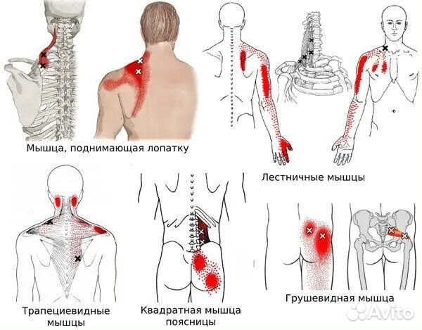 Миопрессура / Массаж триггерных точек
