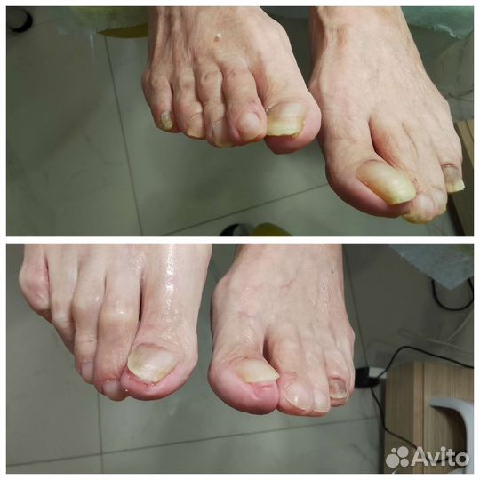 Медицинский педикюр