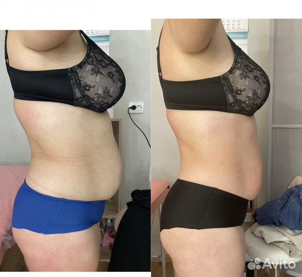 Антицеллюлитный массаж,коррекция фигуры