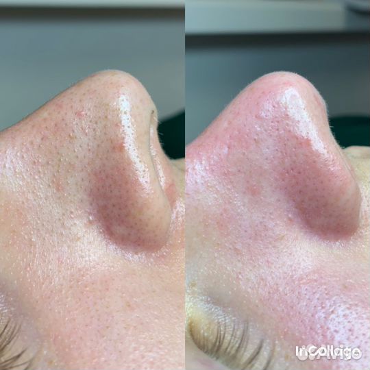 Классический массаж лица