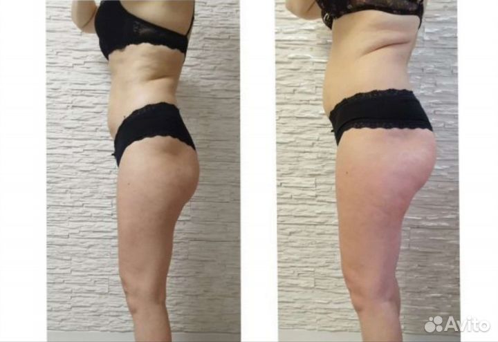 Аппарат Индиба (indiba) Похудение, омоложение