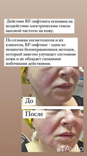 LPG массаж,кавитация,вакуумный массаж,рф лифтинг п