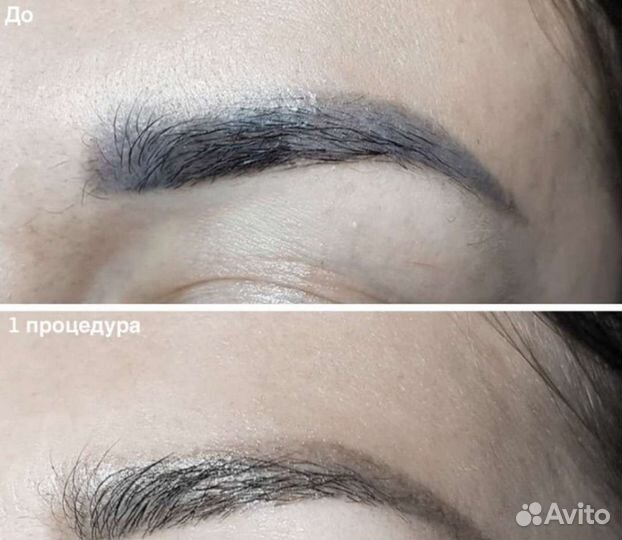 Удаление татуажа ремувером