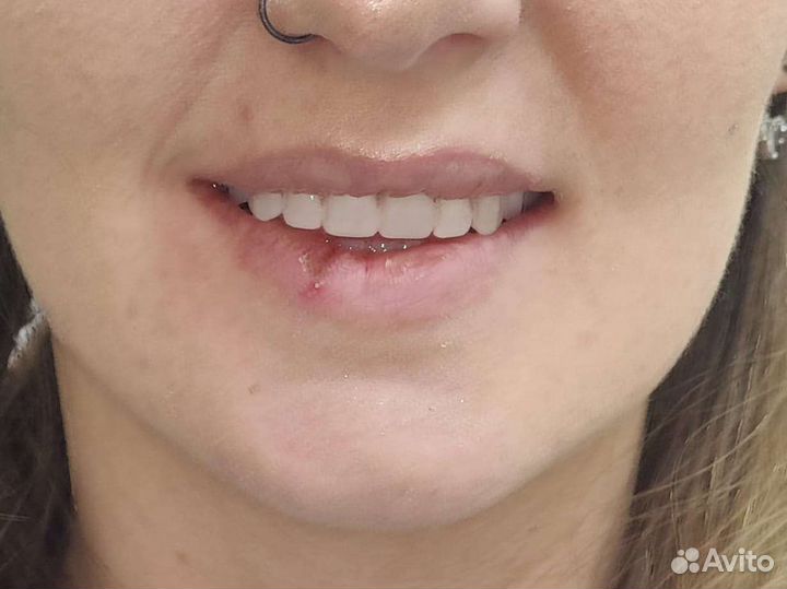 Съемные и несъмные зубные протезы,коронки,ремонт