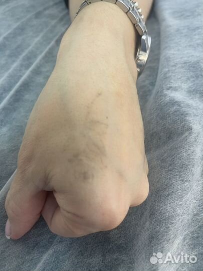 Лазерное удаление тату