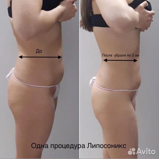 Липосоник для неинвазивной липосакции аренда