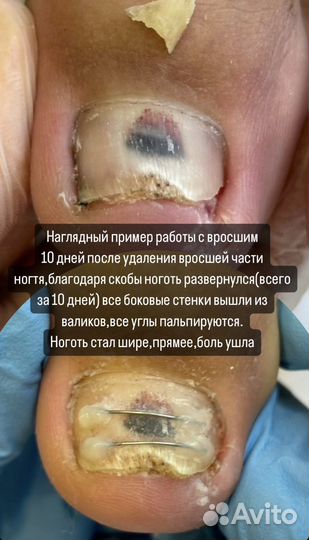 Восстановление ногтей из различных состояний