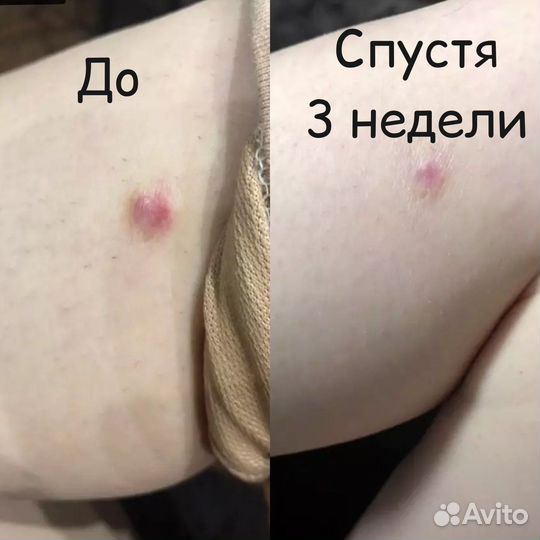 Силиконовый пластырь от рубцов