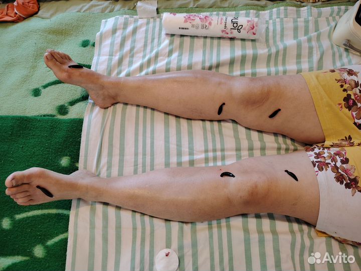 Пиявки медицинские