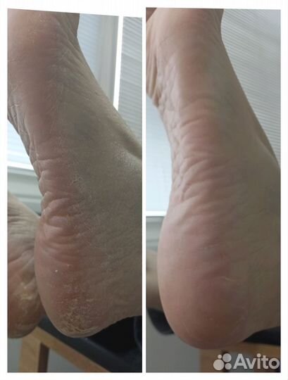 Смарт Педикюр. Педикюр